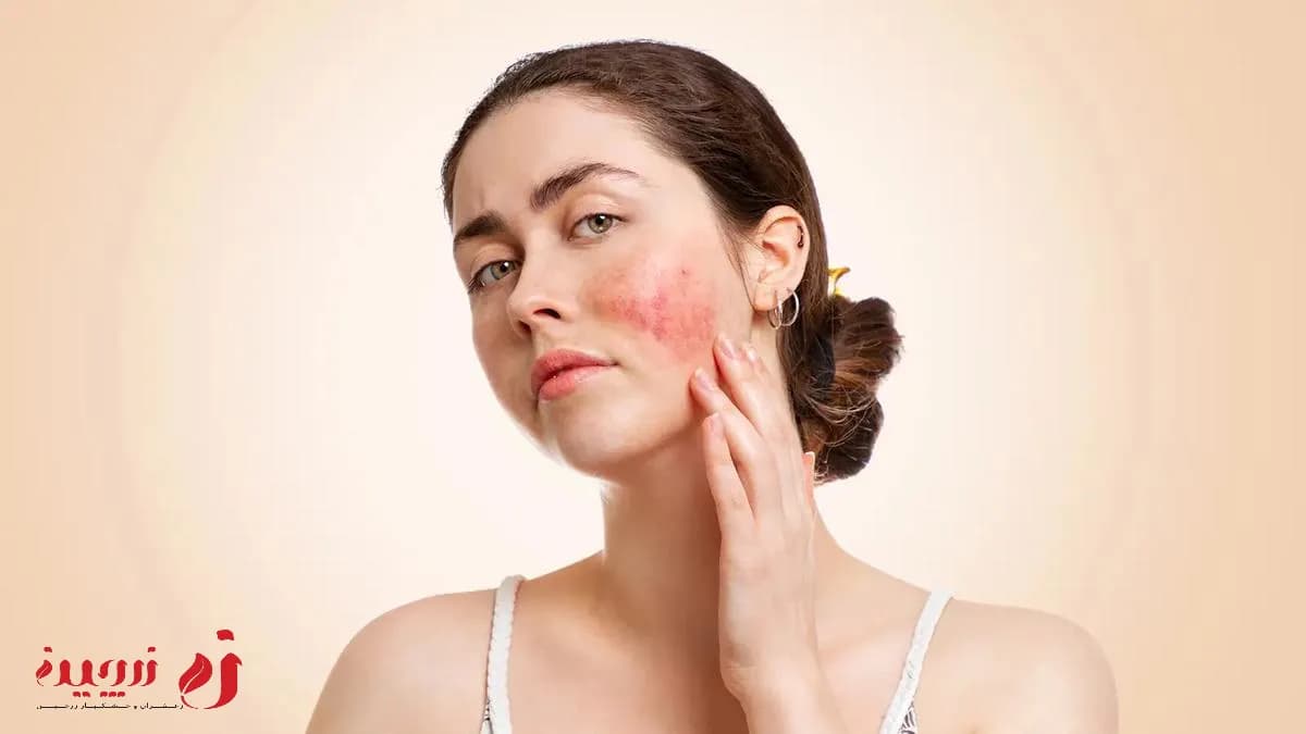 بیماری لوپوس چیست ؟ | علائم، تغذیه مناسب و روش‌های پیگیری1