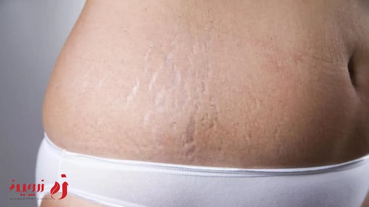 ترک پوستی چیست؟ | چطور می‌توانیم ترک پوستی را درمان کنیم؟